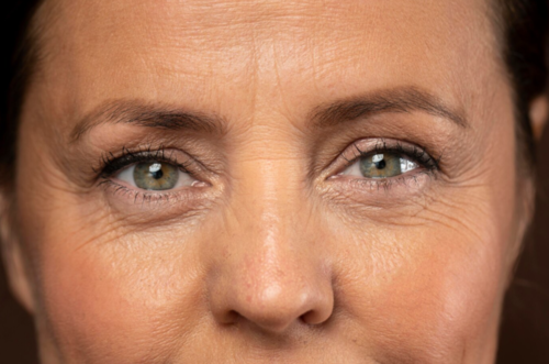 Unveiling Under-Eye Wrinkles: Effective Solutions